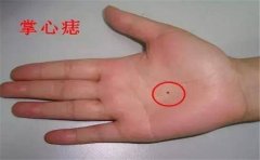 手心的痣相以及其他的手部痣相分析