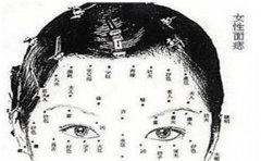 三种罕见痣相注定命中贵人多,注定发财