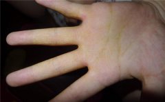 手相看健康,你的手相提示了身体状况如何