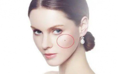 人中有痣好嗎，如果不適合趕緊把痣點掉