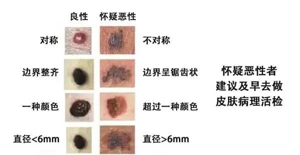 良性痣的图片 良性痣的图片 恶变